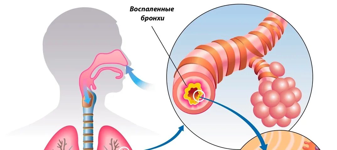 Хронический бронхит картинки.