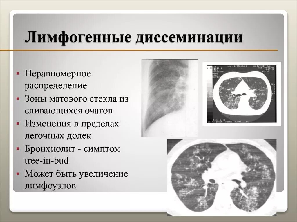 Лимфогенный туберкулез. Диссеминированный туберкулез легких на кт. Мелкоочаговая диссеминация в легких на кт. Лимфогенно диссеминированный туберкулез кт. Диссеминированный туберкулез на кт.