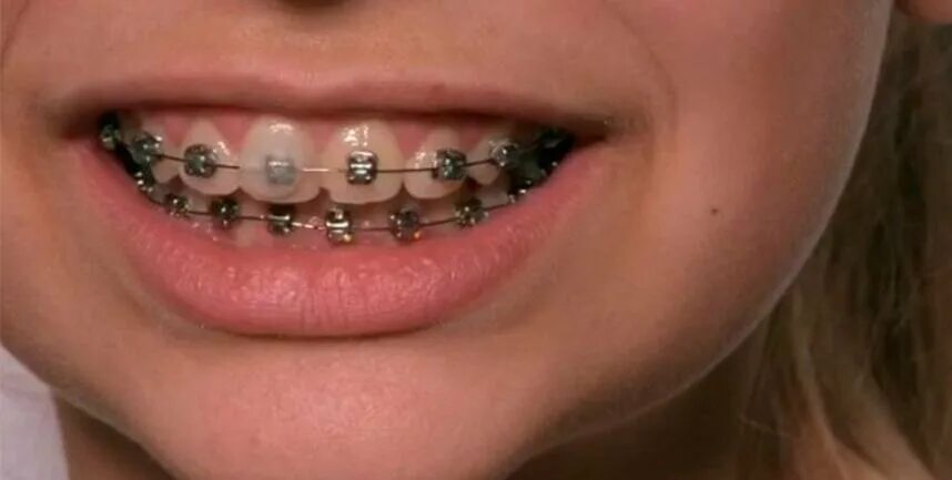 ортодонтический воск revyline. воск для брекетов курапрокс. стоматологический воск для брекетов. силиконовые накладки на брекеты. как пользоваться ортодонтическим воском.