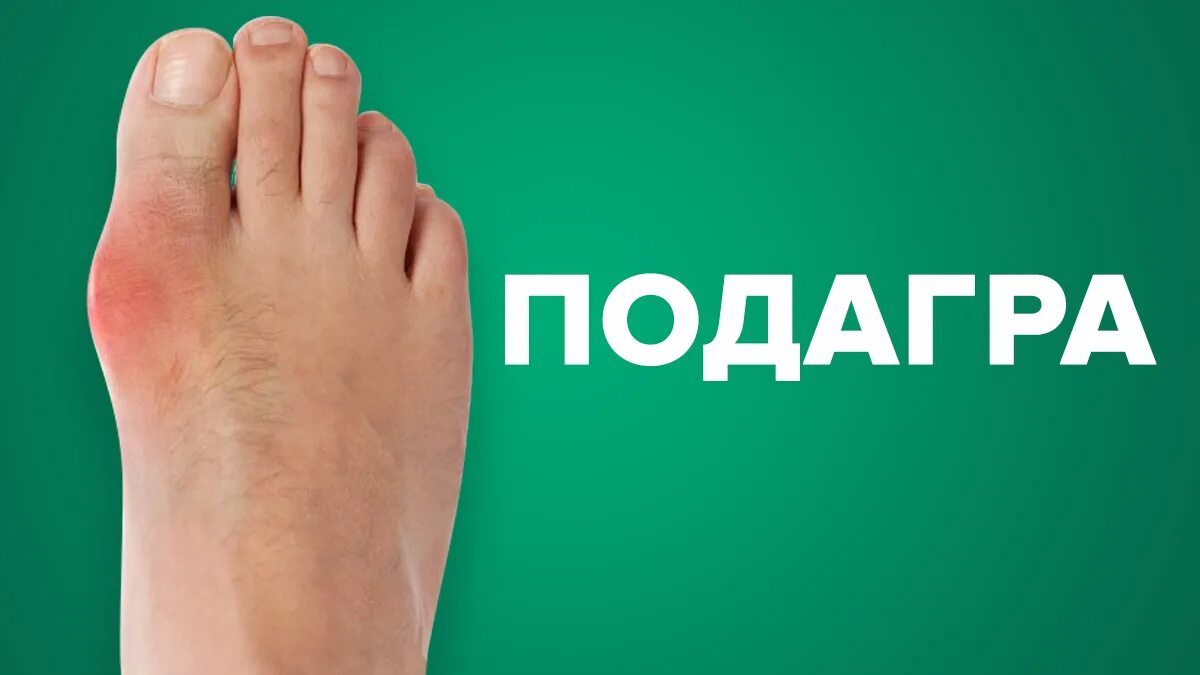 Как вылечить подагру у мужчины на ноге. Как вылечить подагру у мужчины на ноге