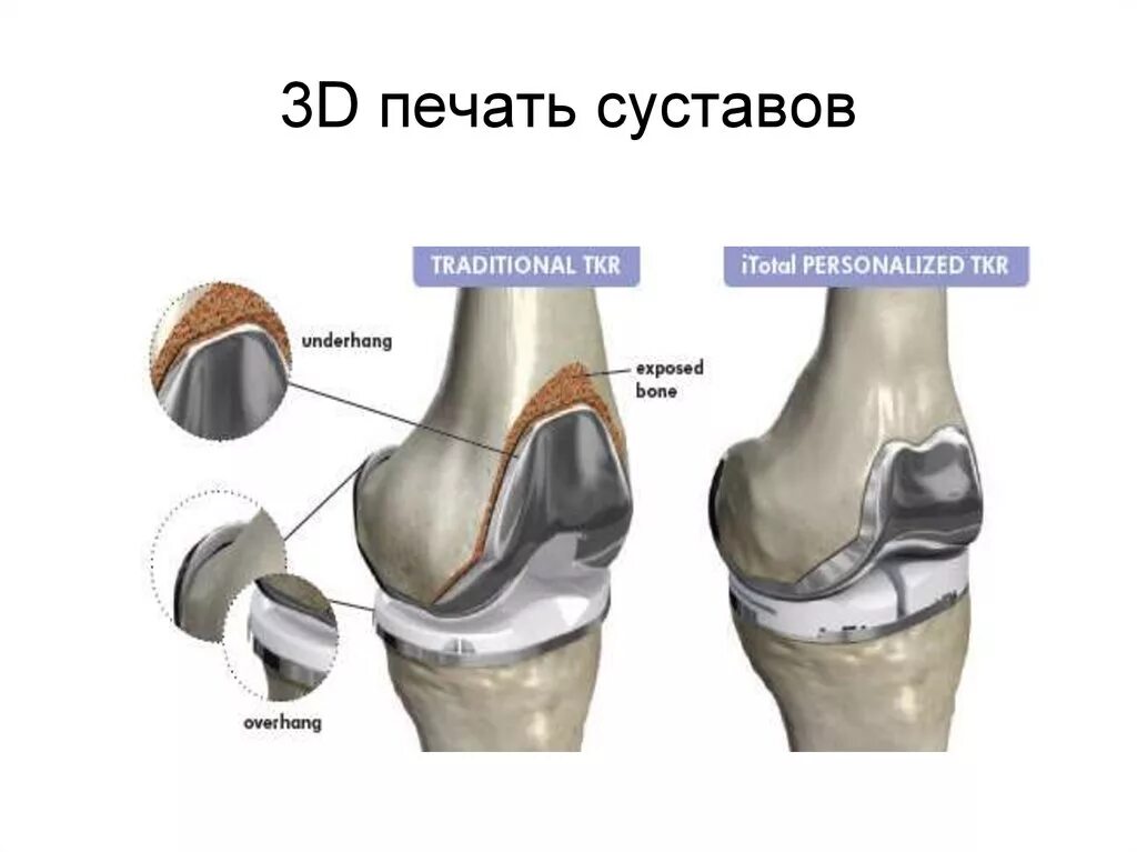 Ростов замена коленного сустава. Искусственный коленный сустав. 3д печать суставов. Импланты коленного сустава. Коленный сустав на 3д принтере.