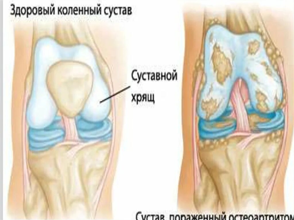 Изменения в коленных суставах. Суставные хрящи коленного сустава.