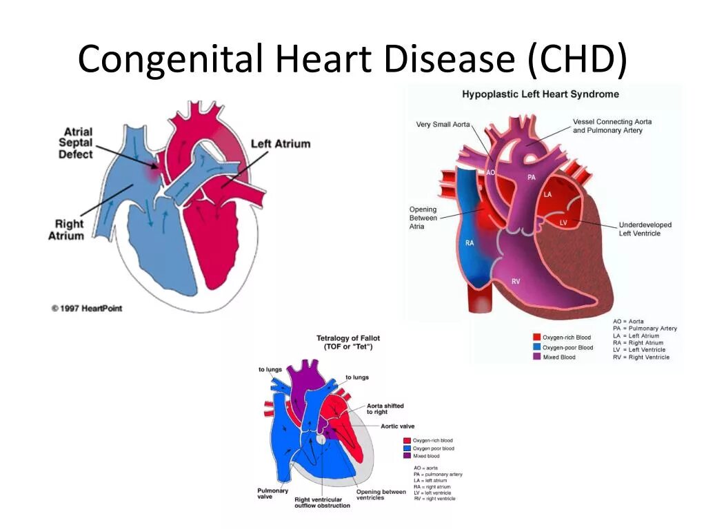 Congenital heart disease. Congenital heart disease. Congenital heart disease. Congenital heart disease. Pulmonary blood flow.