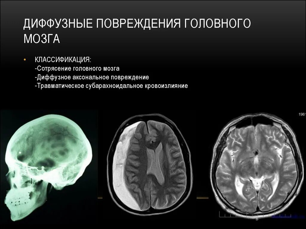 Аксональное повреждение головного мозга на кт. Диффузно аксональные повреждения кт. Диффузно аксональные повреждения головного мозга кт. Кт головного мозга ДАП.