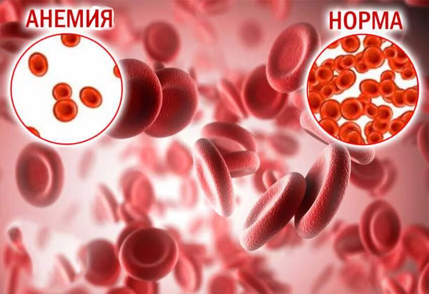 Снижение гемоглобина у мужчин. Fufvfvbz. Анемия картинки. Железодефицитная анемия кровь.