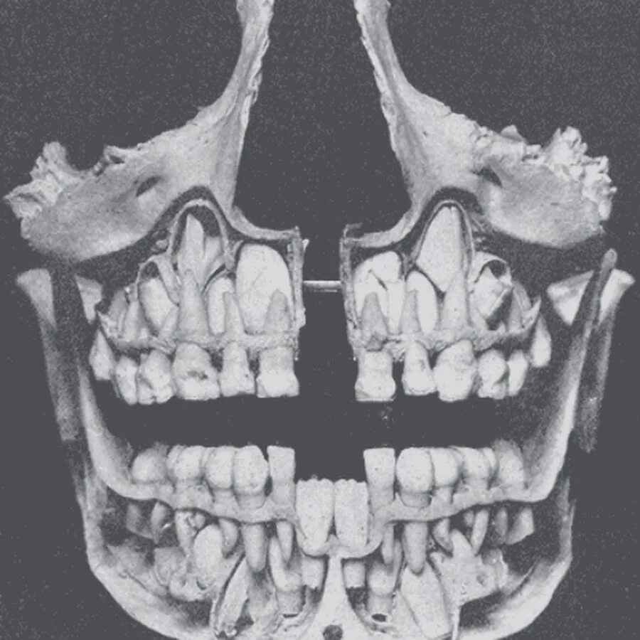 Молочные и коренные зубы рентген. Детский череп рентген