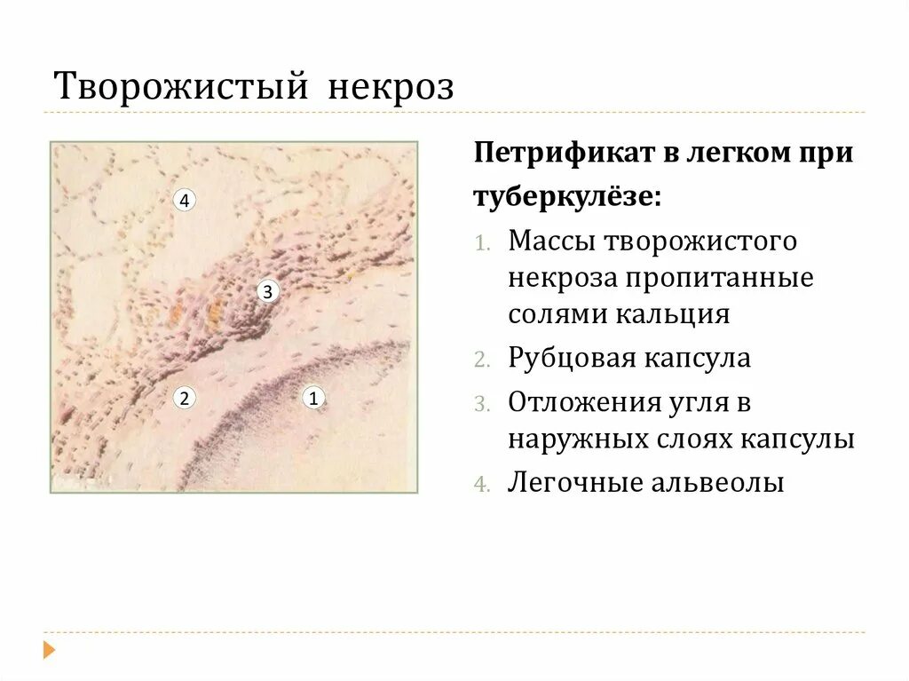 Некроз что это такое и как. Казеозный (творожистый) некроз. творожистый некроз в легком при туберкулезе.