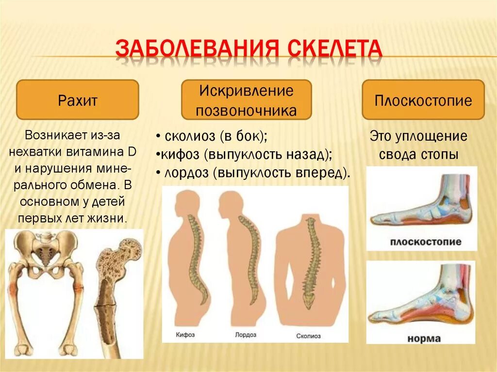 Какие бывают заболевания костей. Заболевания костей скелета. плоскостопие и искривление позвоночника. выявление плоскостопия.