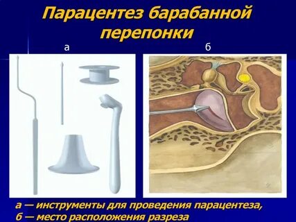 Миринготомия барабанной