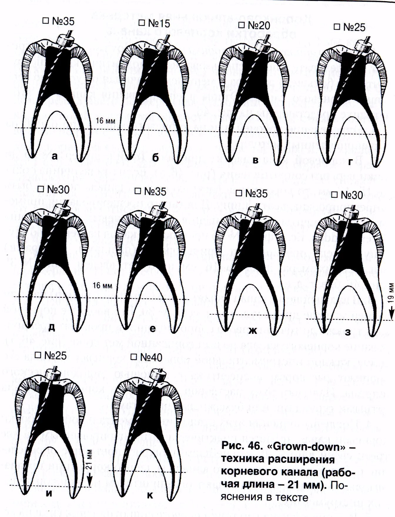 Обработка корневых каналов техники. Стандартная техника расширения корневого канала. Методы препарирования корневых каналов (Crown down).. Этапы препарирования корневого канала методом Crown down. Crown down техника в эндодонтии.