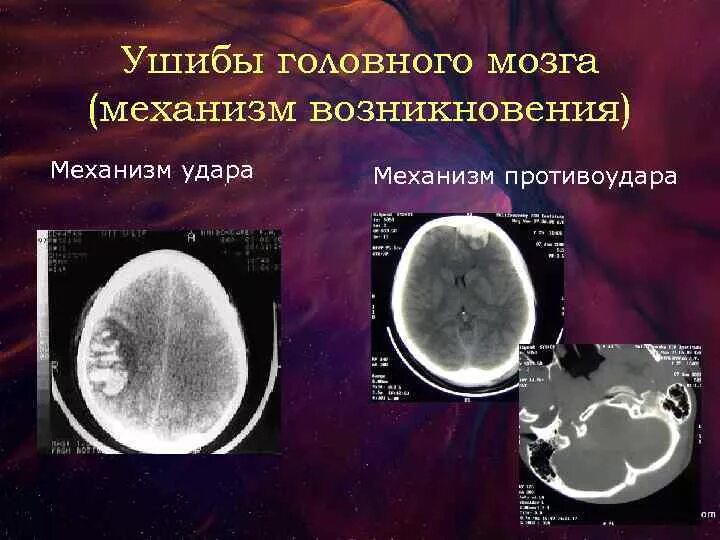 Травма мозга очаговая. Ушиб головного мозга механизм возникновения. Черепно-мозговая травма кт.