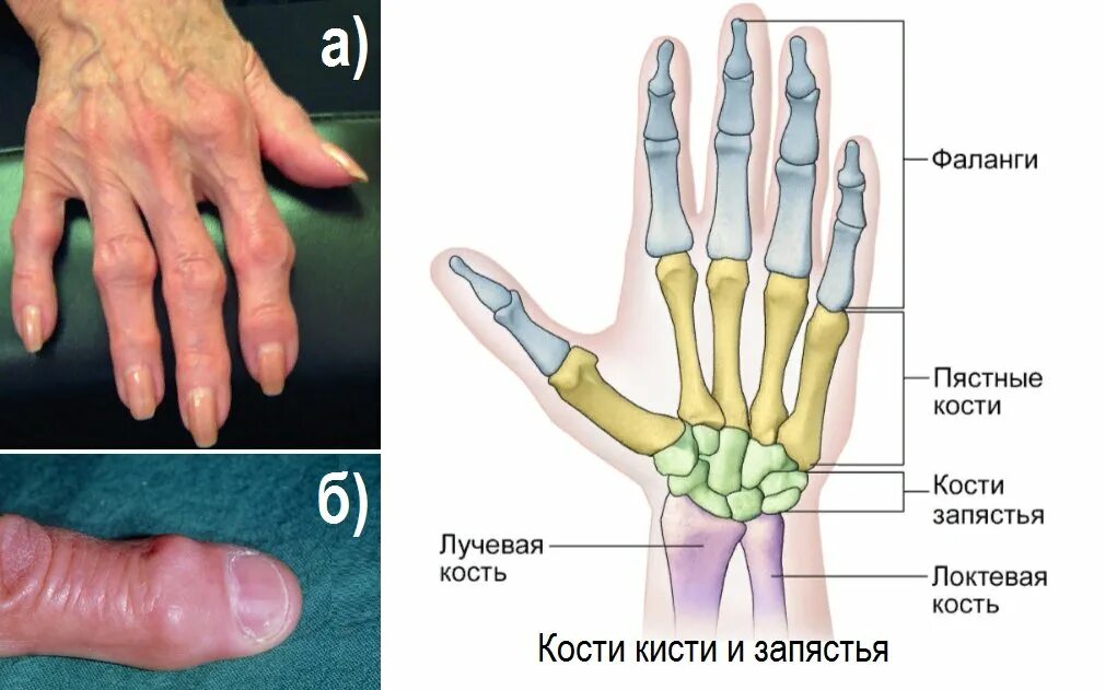 Ревматоидный артрит суставов кистей. Узелки Гебердена и Бушара рентген. Узелки Гебердена рентген. Узелки Гебердена Бушара полиостеоартроз.