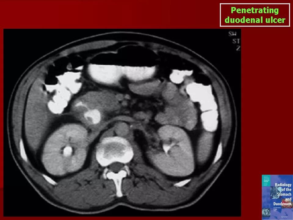 Перфорация язвы ДПК на кт. Перфорация кишечника на кт. Пенетрирующая язва желудка кт. Язва кт