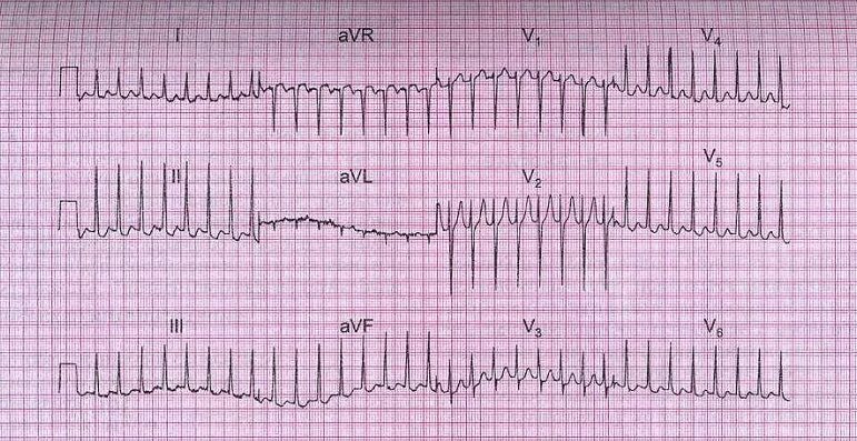 Трепетание предсердий ЭКГ тахисистолия. Фибрилляция предсердий ЭКГ тахисистолия. ЭКГ при фибрилляции предсердий. ЭКГ Мерцательная аритмия тахисистолия.