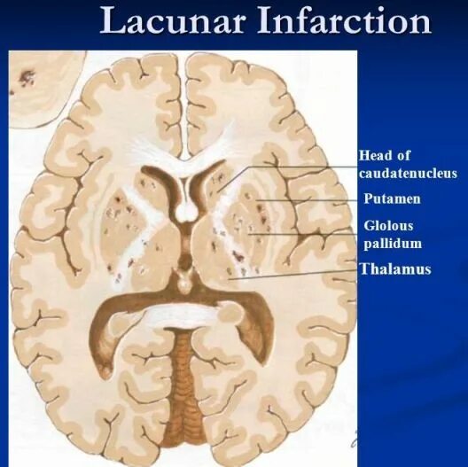 Постишемические кисты мозга. Лакунарной постишемической кисты. Лакунарные кисты в головном мозге. Постишемическая киста в базальных ядрах.