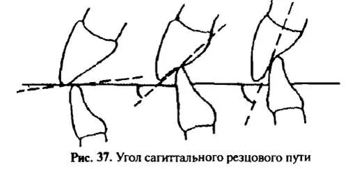 Угол сагиттального резцового пути. Угол сагиттального суставного и резцового пути. схему углов сагиттальных суставного и резцового путей;. угол сагиттального резцового пути равен. угол сагиттального суставного пути равен.