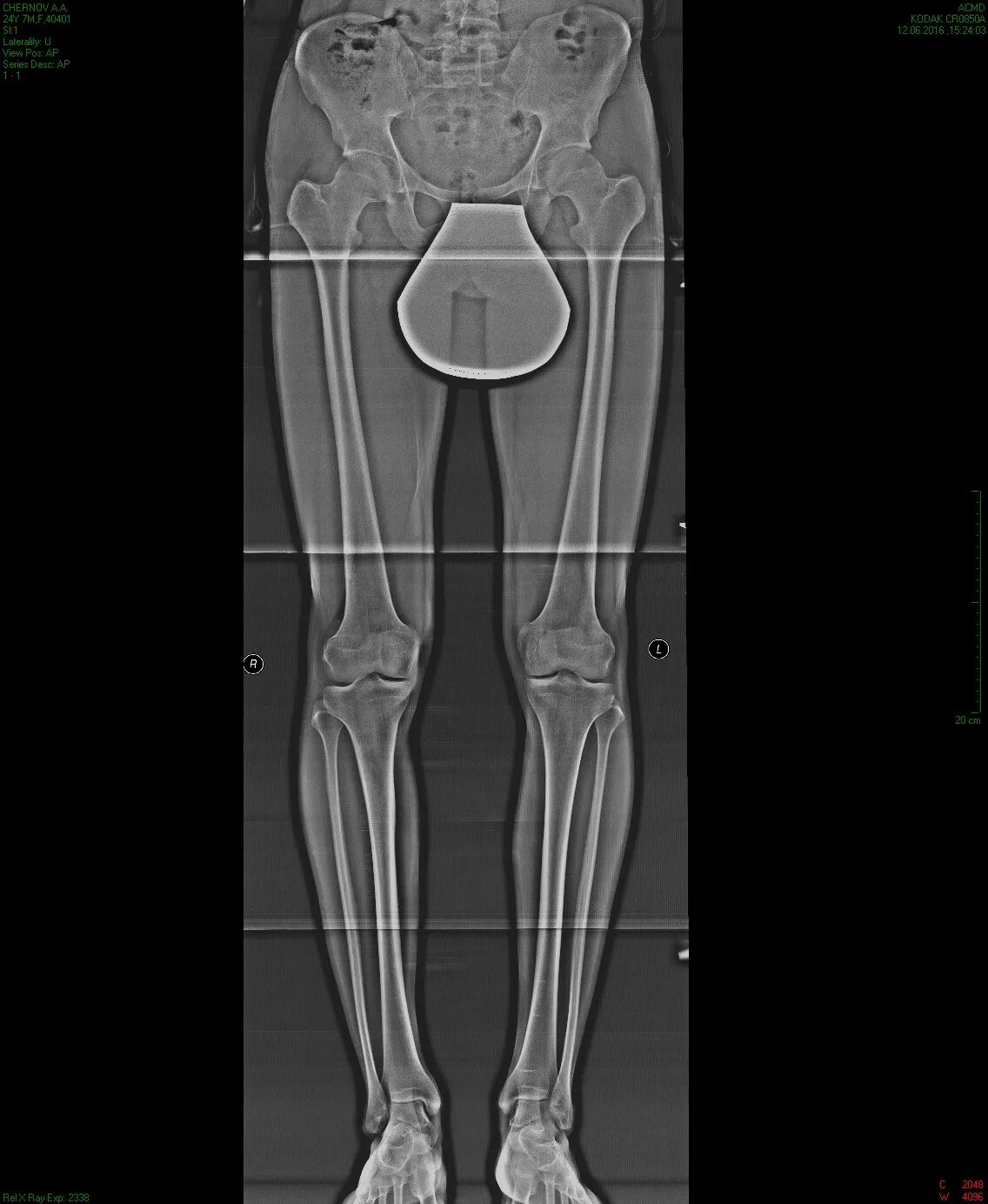 Slot рентген нижних конечностей. Рентген телеметрия нижних конечностей. Рентген таза и нижних конечностей. Рентген костей ног бедра.