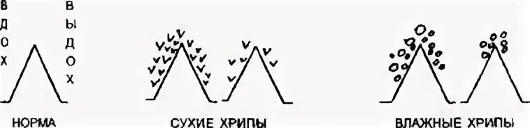 Сухие хрипы виды. Сухие хрипы виды. Сухие свистящие хрипы. Сухие хрипы виды. Влажные хрипы.