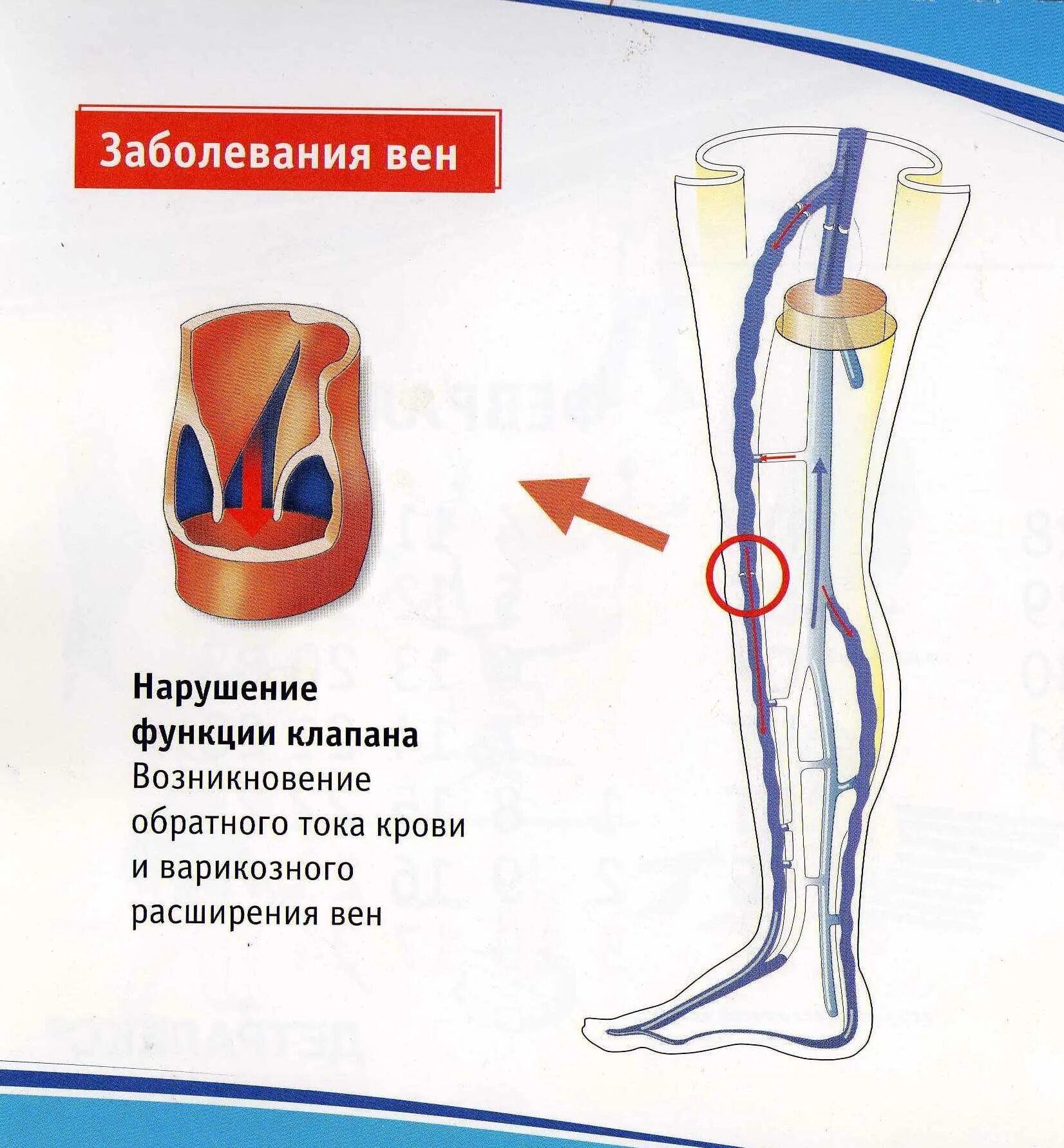 Вены ног клапаны. Хроническая венозная недостаточность (ХВН). Варикозная болезнь вен нижних конечностей ХВН 1. Патогенез венозной недостаточности. Хроническая венозная недостаточность нижних конечностей этиология.