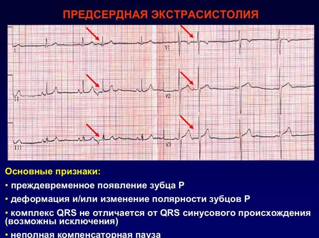 Экстрасистолов