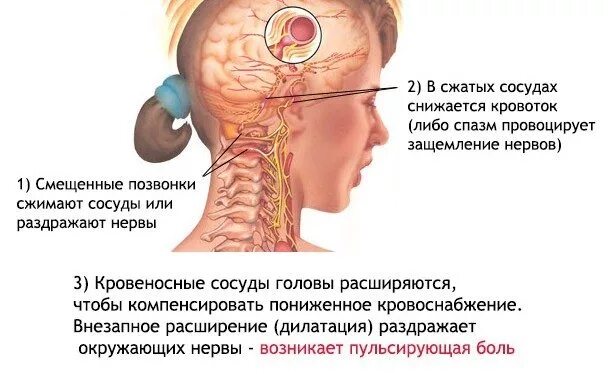 Болит голова. Боль в затылке головы. Болит голова при шейном остеохондрозе.