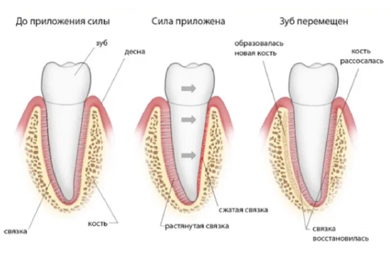 Брекеты схема установки. Зуб.