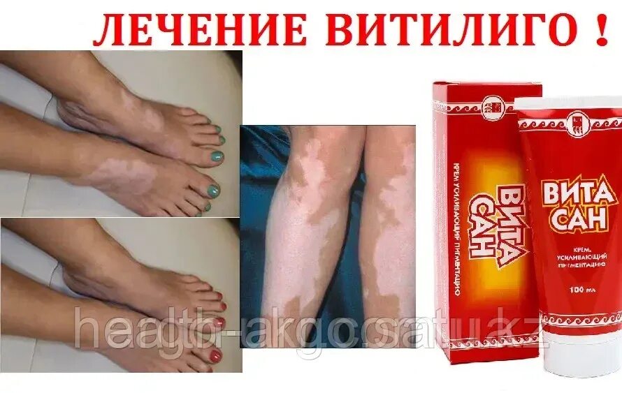Мазь от белых пятен на коже. Цинковая мазь мосфарма. Лекарство от витилиго витасан. Мазь от белых пятен на коже. Мазь от белых пятен на коже.