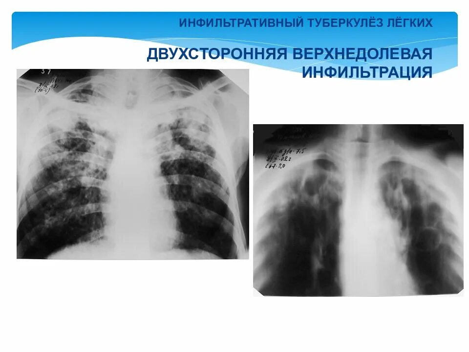 Род туберкулеза. Инфильтративный туберкулёз инфильтраты. Очаговый и инфильтративный туберкулез. Инфильтративный туберкулез рентген. Казеозная пневмония туберкулез.