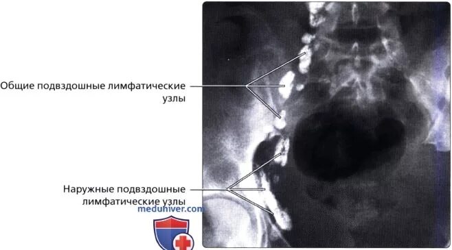 подвздошные лимфоузлы. лимфатические узлы малого таза анатомия. лимфоузлы малого таза анатомия. лимфатические узлы таза схема. лимфатическая система малого таза мужчин.