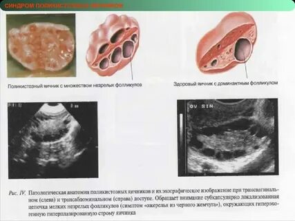 Доминантная фолликула в яичнике что это