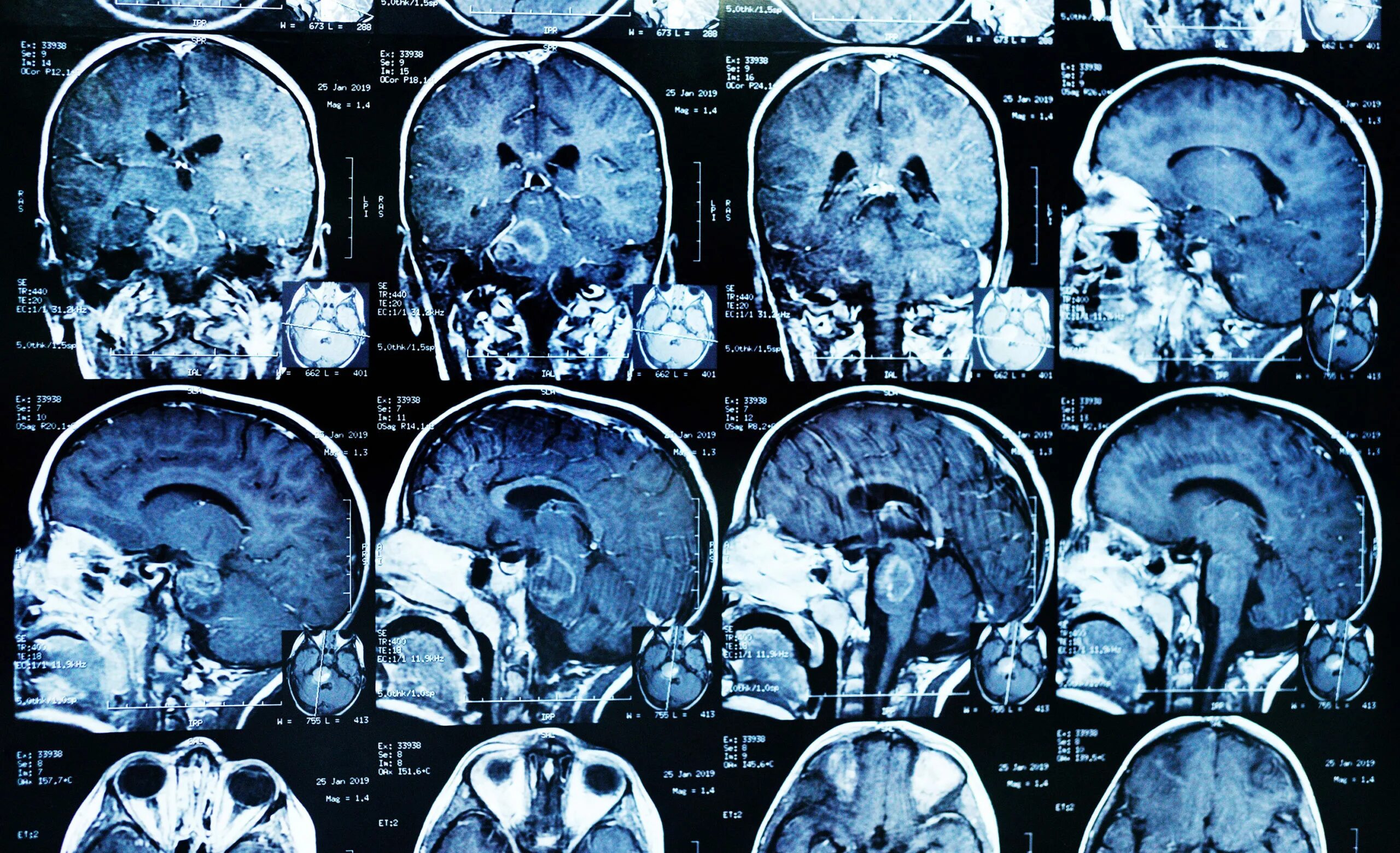 Снимок головного мозга. Опухоль головного мозга на кт. Кт снимок. Мрт снимки. Нейрохирургия мозг