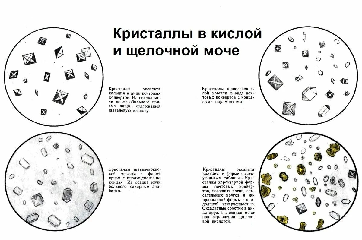 Иглы в моче. Микроскопия мочи Кристаллы мочевой кислоты. Микроскопия мочи кошек. Кристаллы мочевой кислоты микроскопия. Лейкоциты в анализе мочи микроскопия.