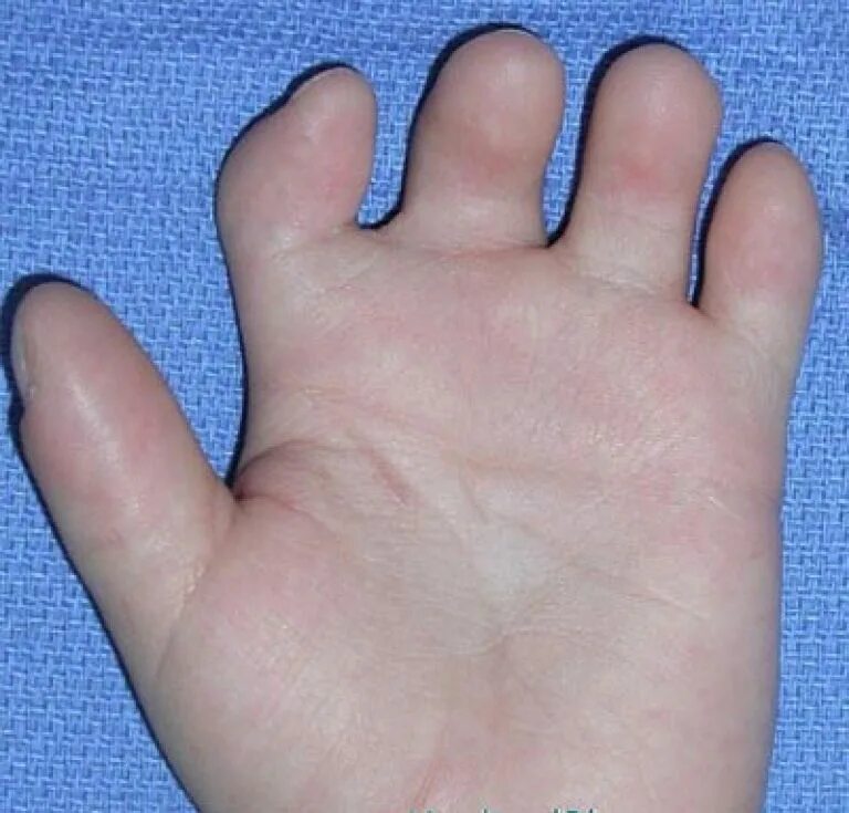 Короткие пальцы у мужчины. Брахидактилия синдактилия. Брахидактилия большого пальца руки. Брахидактилия и эктродактилия.