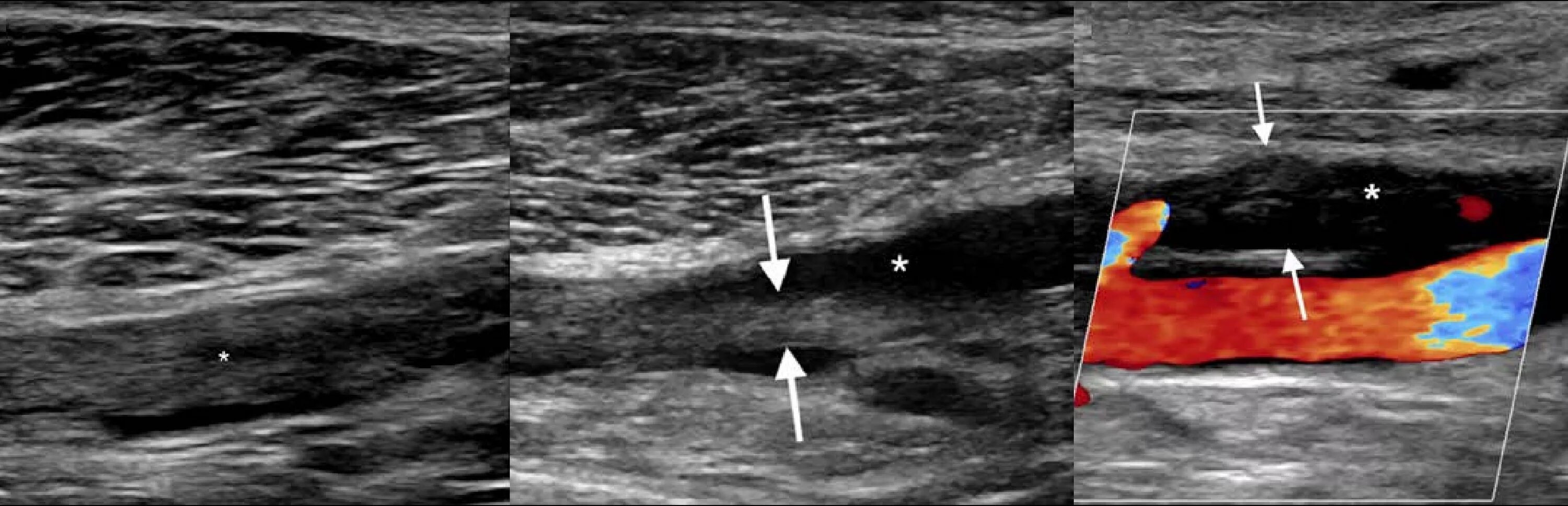 Тромбоз глубоких вен нижних конечностей на УЗИ. Подколенная Вена тромбоз УЗИ. Тромбофлебит ультразвуковое дуплексное ангиосканирование.. Тромбоз подколенной вены на УЗИ. Тромбоз без флотации