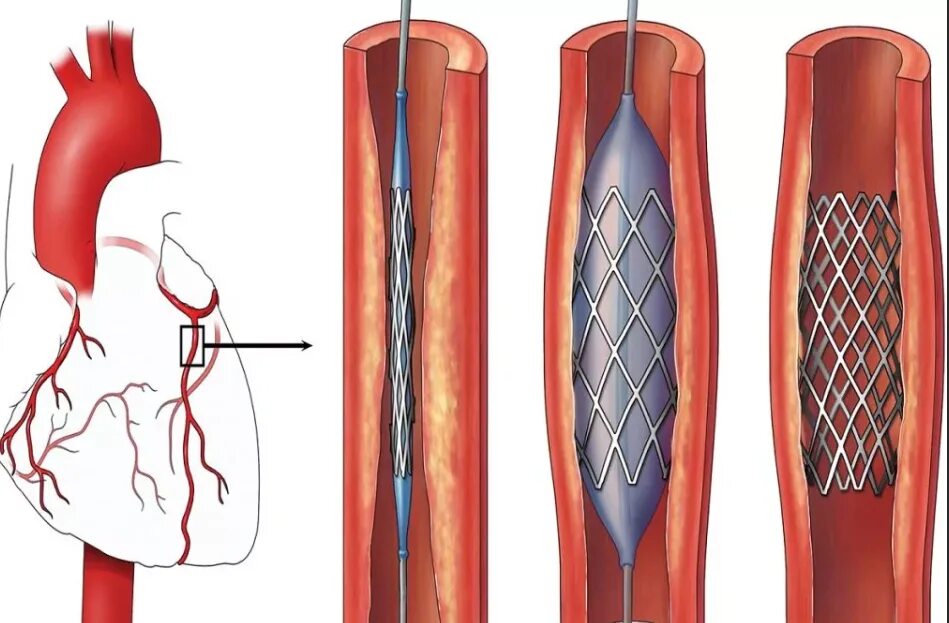 Стент виды. Коронарное стентирование сосудов сердца. ЧКВ баллонная ангиопластика. Баллонная ангиопластика и стентирование артерий сердца.