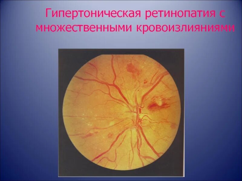 Гипертензивная ретинопатия. Гипертоническая ангиопатия сосудов. Ангиоспастическая ретинопатия. Гипертоническая ретинопатия 1 степени.