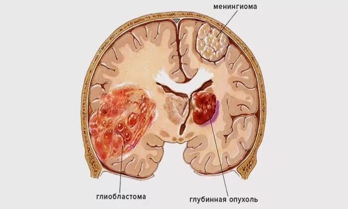 Симптомы глиобластомы головного