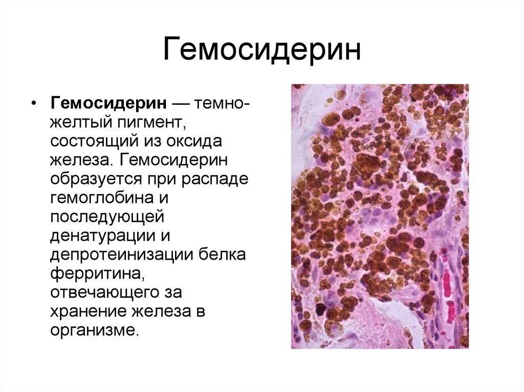 Гемосидерин гистология. Гемосидерин патогенез. Гемосидерин этиология. Гемосидерин кожа гистология. Железо в макрофагах