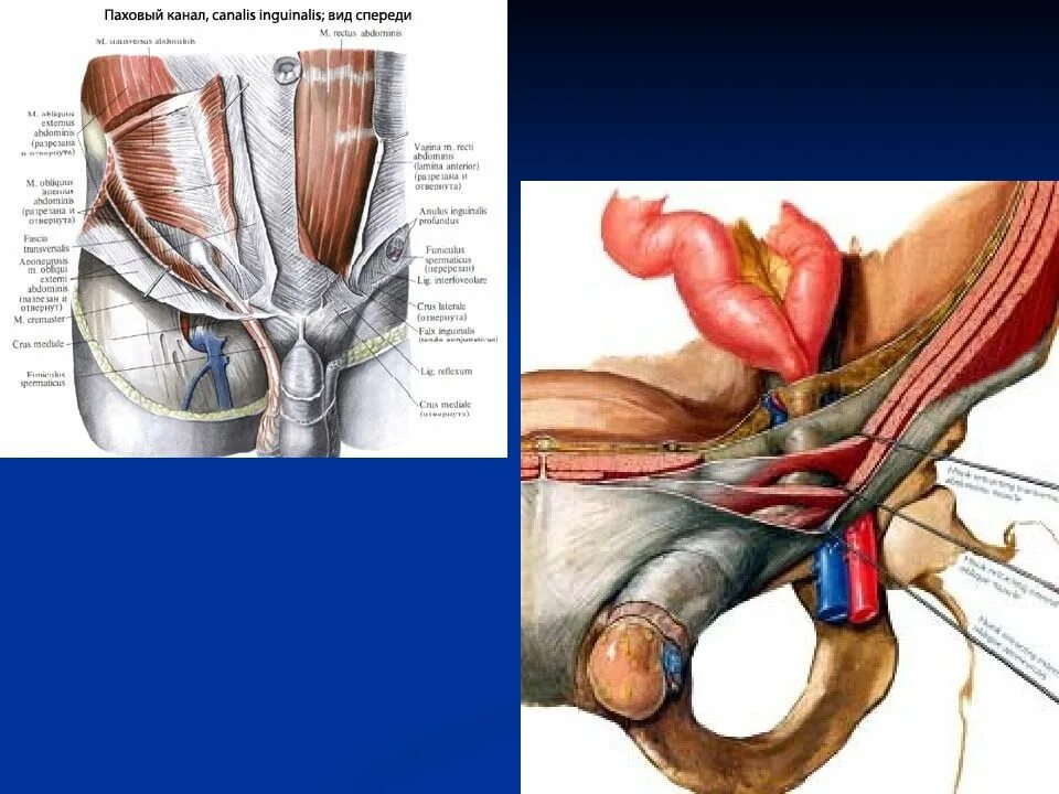 Паховое кольцо у мужчин. Структуры ограничивающие поверхностное кольцо пахового канала. Паховое кольцо у мужчин. Паховое кольцо у мужчин. Паховая грыжа анатомия пахового канала.