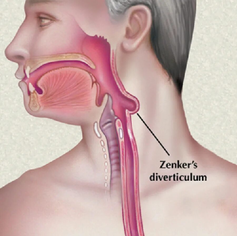 Ценкеровские дивертикулы пищевода. Дивертикул гортаноглотки - Ценкера. Глоточно пищеводный дивертикул Ценкера. Ком в горле причины и боль желудке