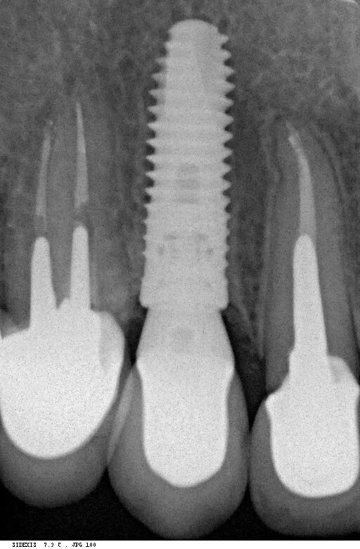 имплант на рентгене. остеоинтеграция имплантата рентген. Alpha bio импланты рентген. рентгеновский снимок с имплантами. осстем периимплантит рентген.