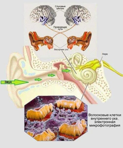 Слуховая нейропатия. Слуховая нейропатия у детей. Слуховая (аудиторная) нейропатия. Волосковые клетки уха. Чувствительные клетки внутреннего уха