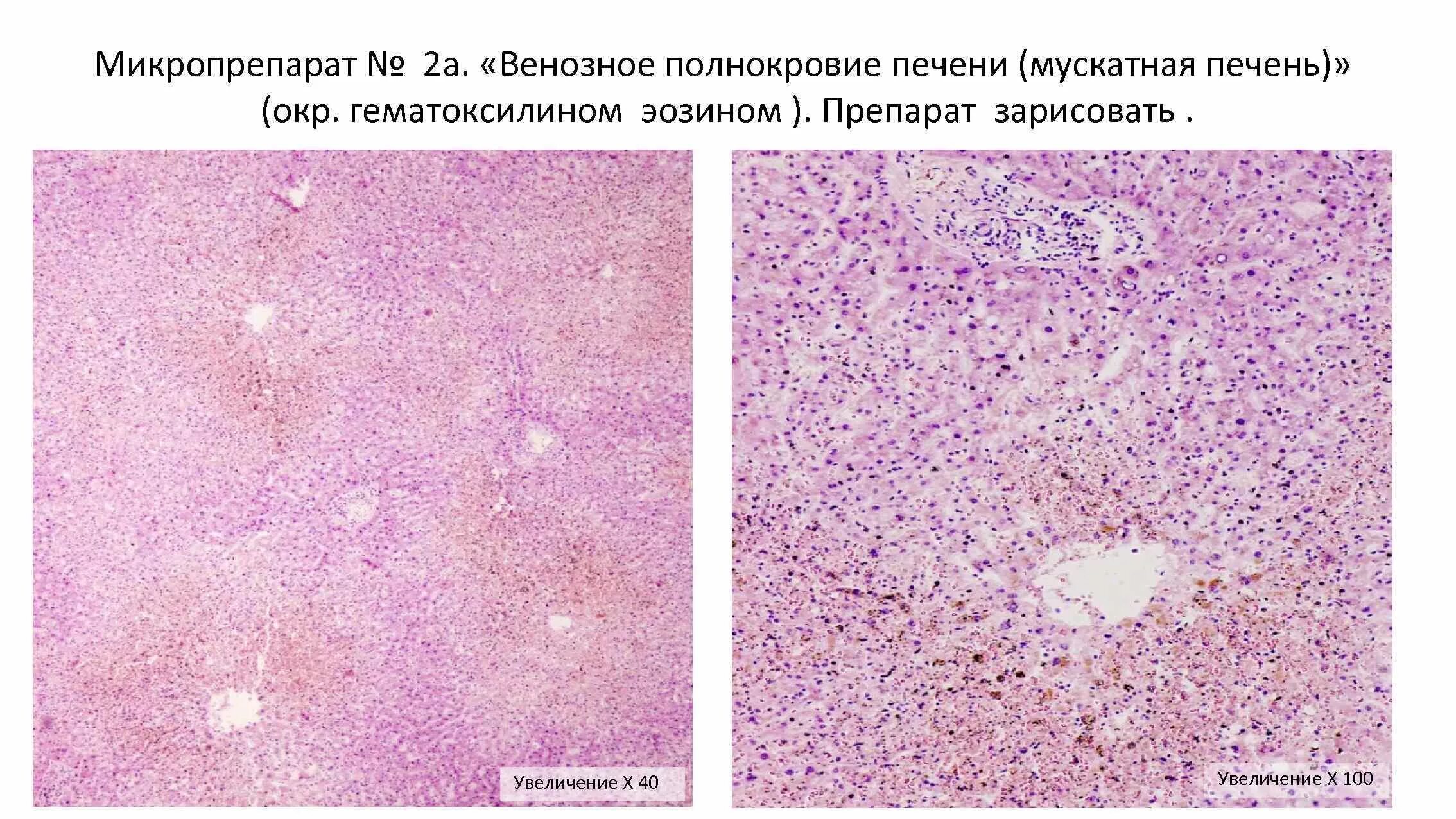 Печень микропрепарат описание. Венозное полнокровие печени мускатная печень микропрепарат. Венозное полнокровие печени микропрепарат. Мускатная печень патанатомия макропрепарат. Венозное полнокровие печени (мускатная печень) макропрепарат.