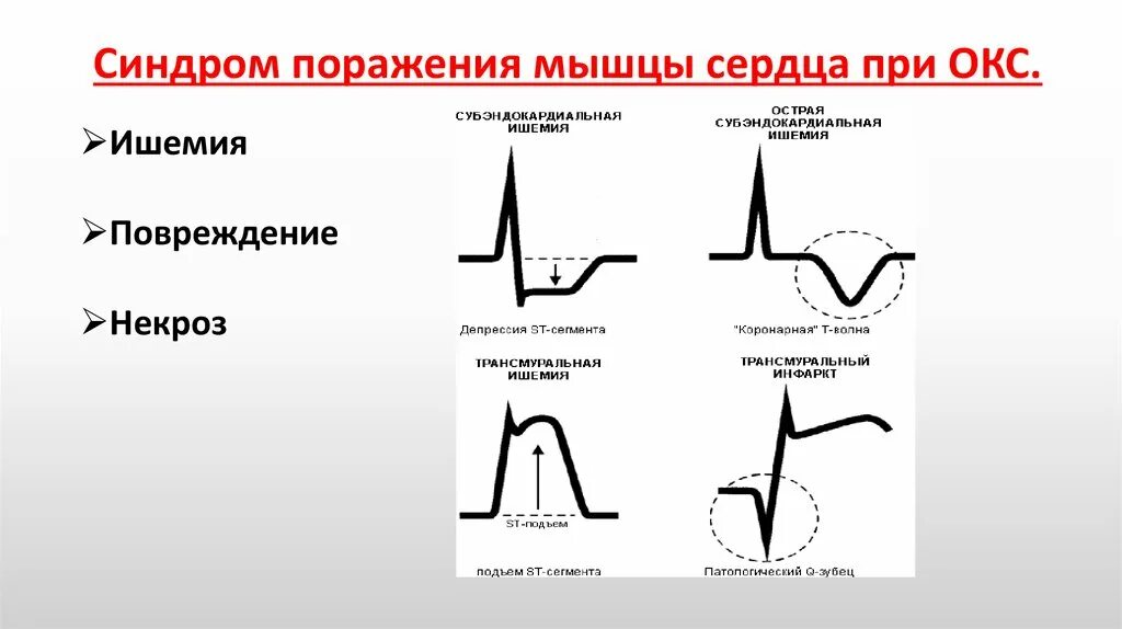 St ишемия. Признак некроза миокарда на ЭКГ. Критерии ишемии миокарда на ЭКГ. Трансмуральный инфаркт острая стадия на ЭКГ. Субэпикардиальная и субэндокардиальная ишемия на ЭКГ.