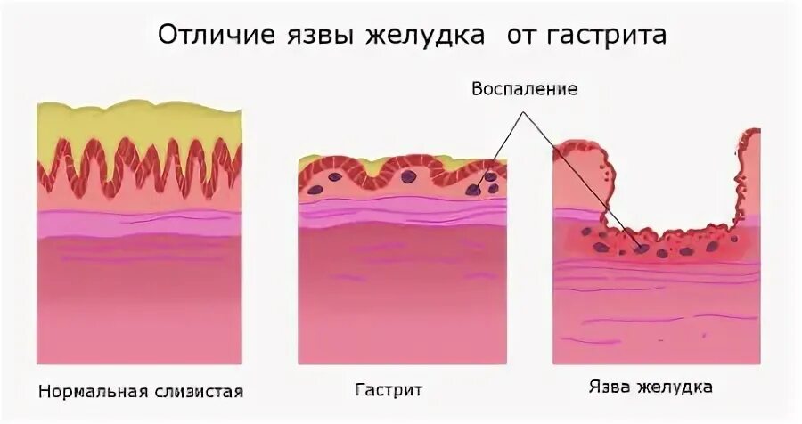 Симптомы язвы желудка и гастрита отличия. Дифференциальный диагноз язвенной болезни желудка. Диф диагноз язвенной болезни желудка. Гастрит и язвенная болезнь желудка. Чем отличается гастрит от язвы.