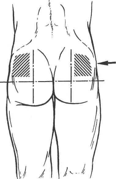 Как не больно сделать укол в ягодицу. Место для укола в ягодицу наружный верхний Квадрант. Укол в верхний наружный Квадрант ягодицы. Место для внутримышечной инъекции Квадрант ягодицы. Схема укола внутримышечно в ягодицу.
