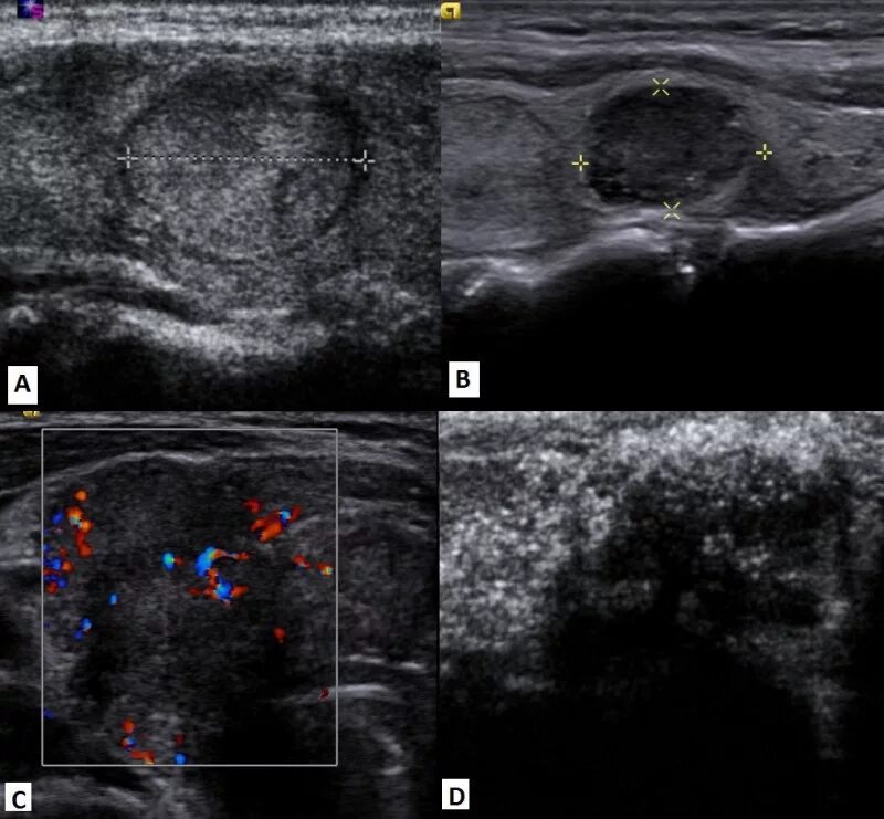 Эхограммы узлы щитовидной железы. Щитовидная железа узелок на УЗИ. Фолликулярная аденома щитовидной железы УЗИ. ДТЗ на УЗИ щитовидной железы. Диффузно узловое образование