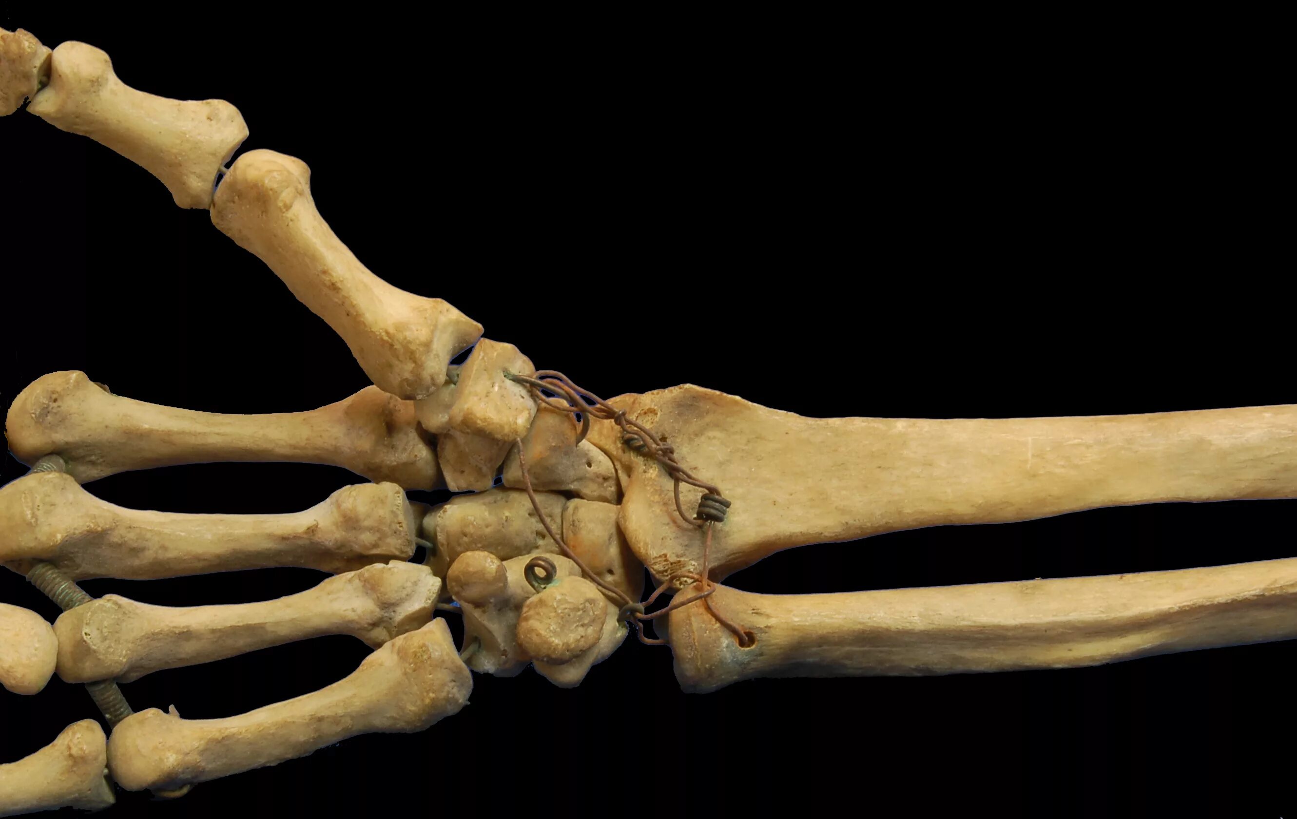 Кости лучезапястного сустава. Скелет лучезапястного сустава. Гороховидная кость анатомия. Пястная кость головчатая кость. Скелет запястья человека