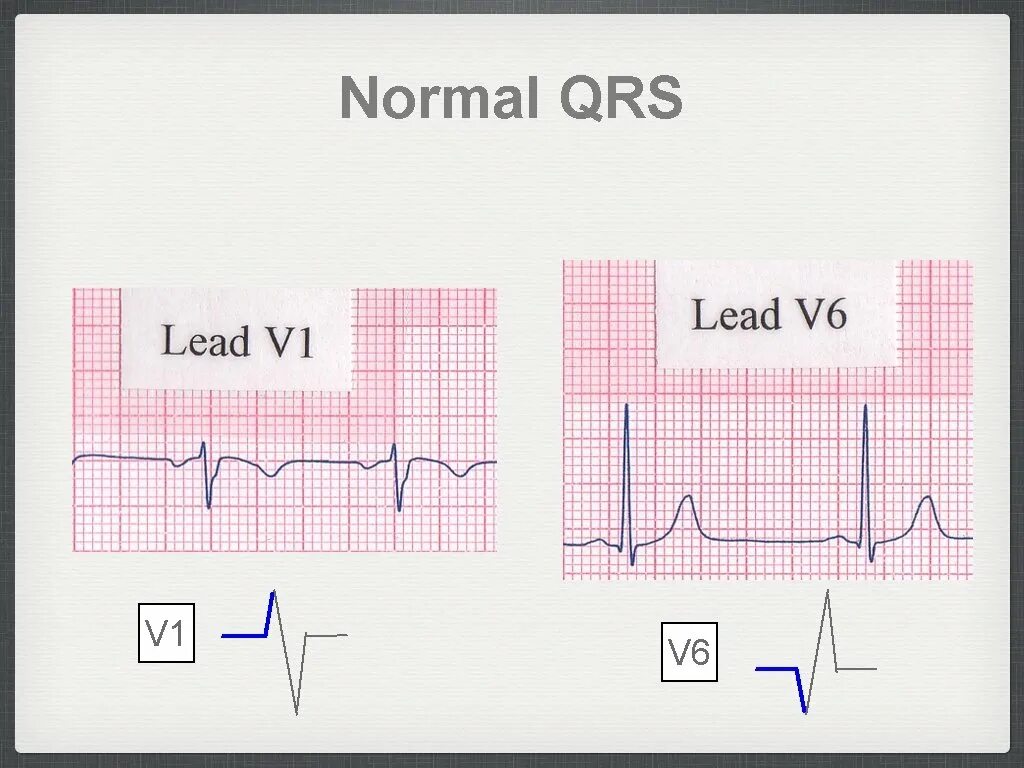 QRS В v1. Положительный QRS В v1. Измененный сегмент QRS В v1. Детектор QRS комплексов схема.