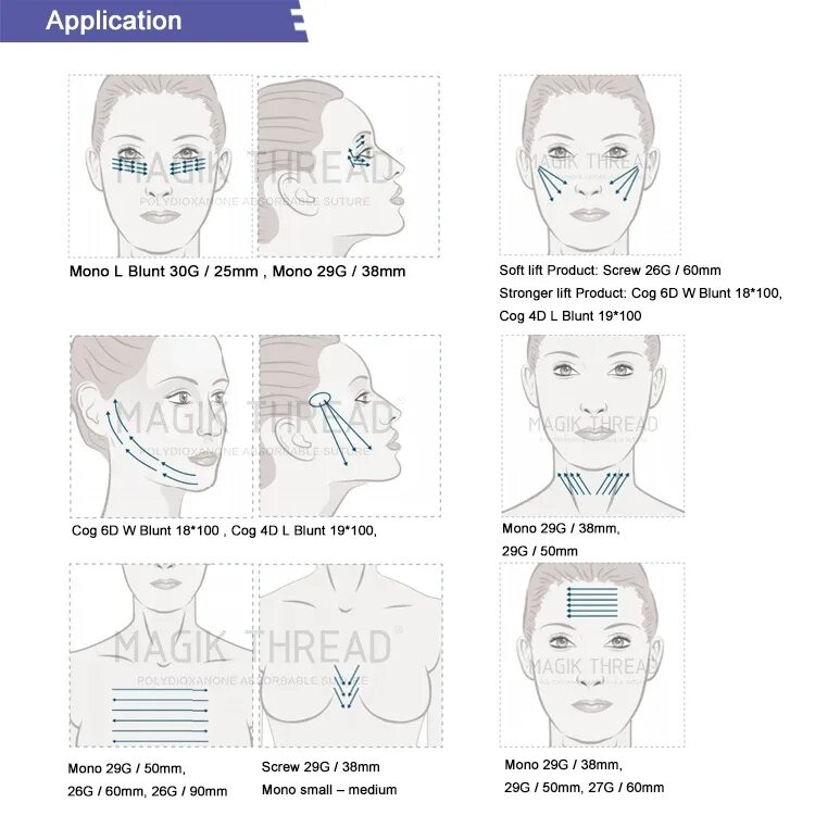 Схема постановки нитей Скрю. Схема постановки нитей Коги для подтяжки лица. Мезонити схема. Нитевой лифтинг схема. Схема подтяжки лица